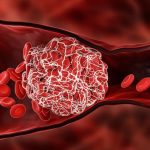 تلك الأطعمة تسبب جلطات خطيرة بالجسم