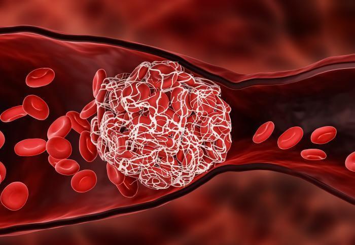 تلك الأطعمة تسبب جلطات خطيرة بالجسم
