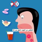 التخلص من التهاب الحلق